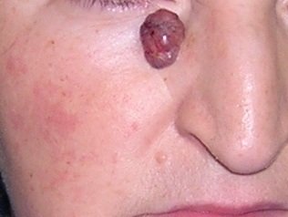 Bazocelularni karcinom na licu