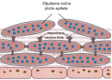 deskvamacija-celijskog-plocastog-epitela