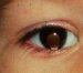 coloboma