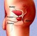 nespecifični-uretritis