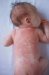erythrodermia-desquamativa