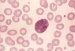 erythrodermia-ichthyosiformis-congenitalis-bullosa