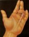 contractura-dupuytren