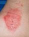 numularni-ekcematoidni-dermatitis