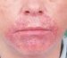 dermatitis-perioralis