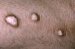calcinosis-cutis-dystrophica