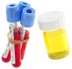kada-i-zašto-je-povećana-urea-u-krvi