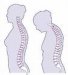 osteoporoza-poroznost-kostiju