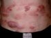mycosis-fungoides