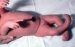 artrogripoza-arthrogryposis