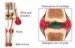 poliartritis