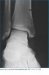 osteohondroza