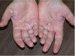 tinea-manum