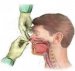 juvenilni-fibrom-nazofarinksa