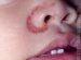 dermatitis-seborrhoica-infantum