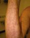 livedo-reticularis