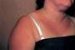 urticaria-solaris