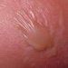 herpes-gestationis