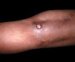 calcinosis-cutis-circumscripta