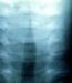 laryngotracheobronchitis-acuta-suffocans