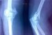 interkondilarni-prelomi-humerusa-fractura-intercondylaris-humeri