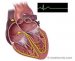bolest-sinusnog-čvora-sick-sinus-syndrome