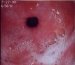 akutni-gastritis