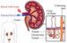 glomerulonefritis