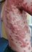 impetigo-bullosa