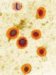 mumps-meningitis