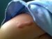 keloid