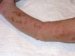 incontinentia-pigmenti