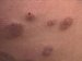 erythema-elevatum-et-diutinum