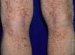 capillaritis-alba