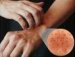 fotoalergijski-kontaktni-dermatitis