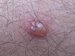 dermatitis-papulosa-gestationis