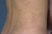 angiokeratoma-corporis-diffusum