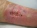 calcinosis-cutis-metabolica