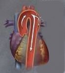 bolesti-grudne-aorte