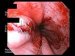 ruptura-gastroezofagusne-spojnice-syndroma-mallory-weiss