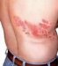 herpes-zoster