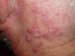seboreja-seboroični-dermatitis