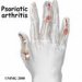 psorijazni-artritis
