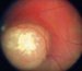 retinoblastom