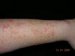 erythrodermia-symmetrica-progressiva