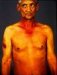 thrombophlebitis-migrans