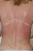 fototoksične-dermatoze
