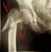 subtrohanterni-prelomi-femura-fractura-subtrochanterica-femoris