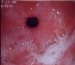 postoperativni-refluks-gastritis