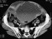 hematom-ovojnice-m-rectus-abdominisa